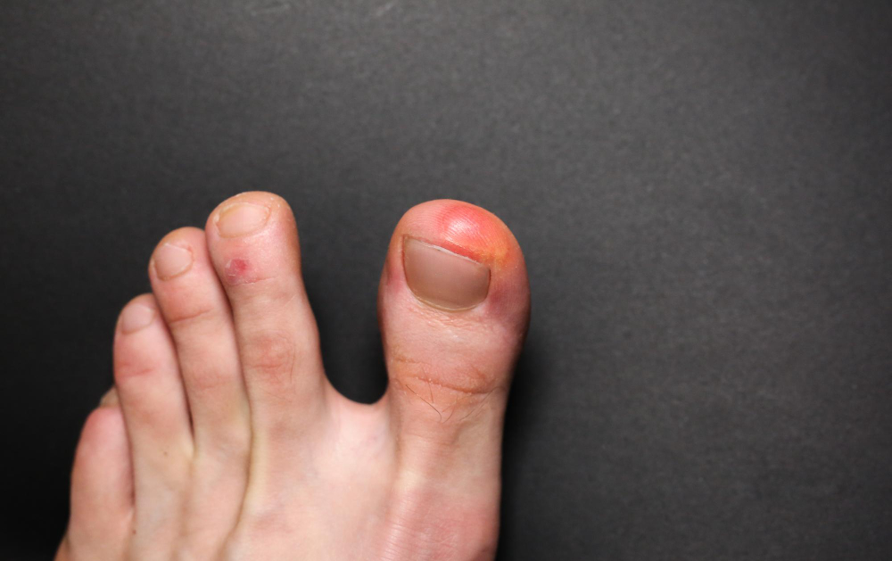 Plantar Fasciitis